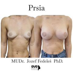 Zväčšenie pŕs - MUDr. Jozef Fedeleš PhD.