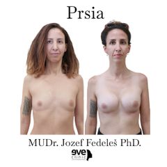 Zväčšenie pŕs - MUDr. Jozef Fedeleš PhD.