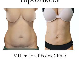 Liposukcia pred a po - 858539