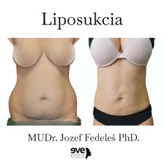 Liposukcia - MUDr. Jozef Fedeleš PhD.