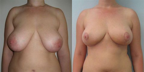 redukcia pred 1