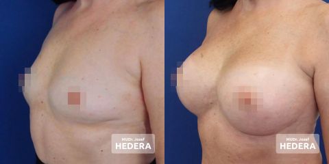 INK chir hedera augm 3 pred new