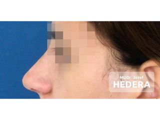 Operácia nosa (Rhinoplastika) - MUDr. Jozef Hedera
