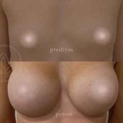 Zväčšenie pŕs - FRAIS - Inštitút zdravia a krásy