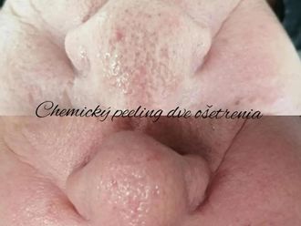 Chemický peeling pred a po - 807307