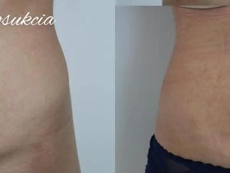 Laserová dermatológia pred a po - 807308