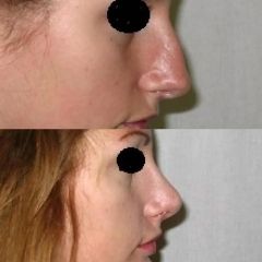 Plastická operácia špičky nosa