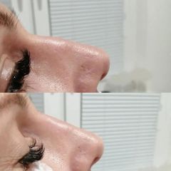 Plastická operácia špičky nosa