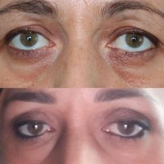 Operácia očných viečok (Blepharoplastika)