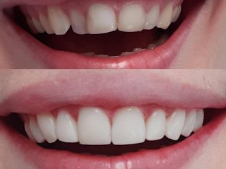 Zubné implantáty - 848360