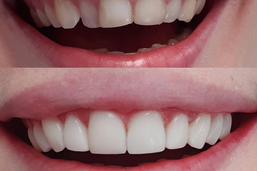Zubné implantáty pred a po - 848360