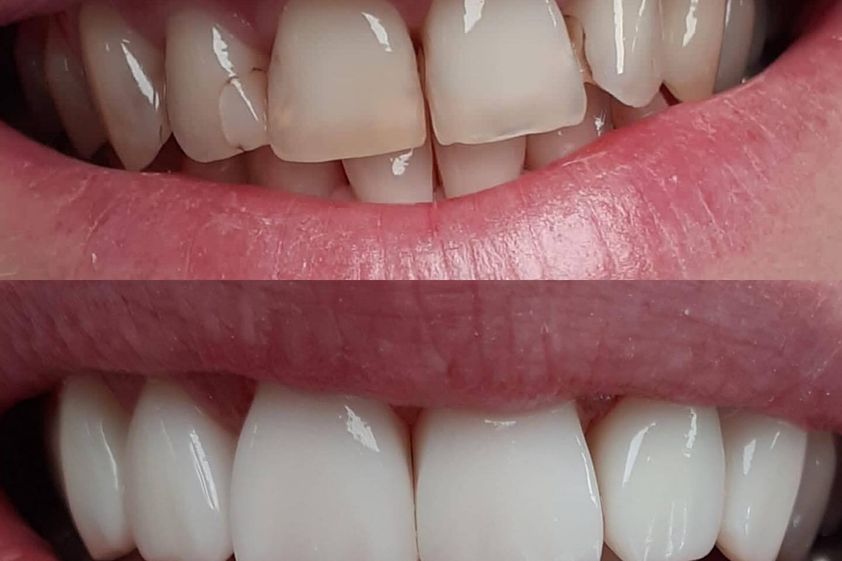 Zubné implantáty pred a po - 857293