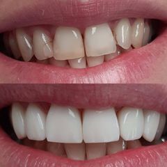Zubné implantáty - Scarlett Clinic