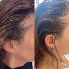 Transplantácia vlasov - Scarlett Clinic