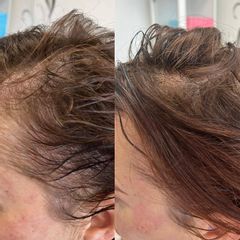 Transplantácia vlasov - Scarlett Clinic