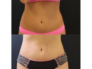 Alternatíva liposukcie - neinvazívne odstránenie tuku a celulitídy