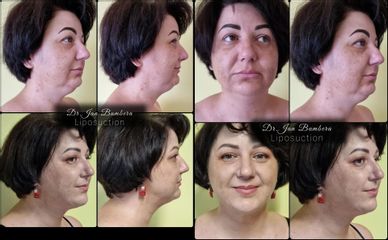 Liposukcia, dolnej časti tváre, krku - MUDr. Ján Bumbera