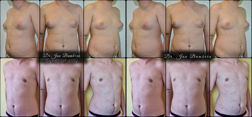 Gynekomastia (Combination of gland extirpation and Liposuction) - MUDr. Ján Bumbera