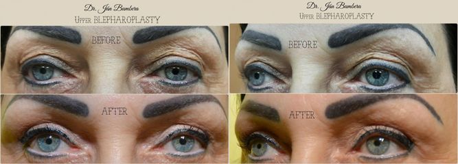Operácia očných viečok (Blepharoplastika), Pred a 6 týždňov Po.