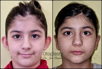 OTOPLASTY - MUDr. Ján Bumbera