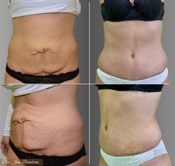 Abdominoplasty - MUDr. Ján Bumbera