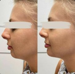 Niťový lifting - CRYSTAL ESTHETIC CLINIC