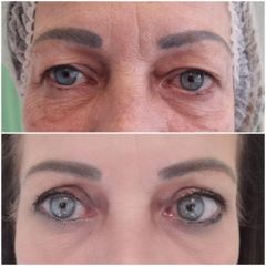 Operácia očných viečok (Blepharoplastika) - CRYSTAL ESTHETIC CLINIC