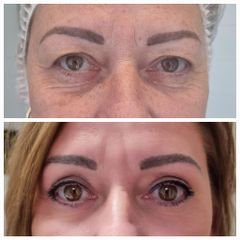 Operácia očných viečok (Blepharoplastika) - CRYSTAL ESTHETIC CLINIC