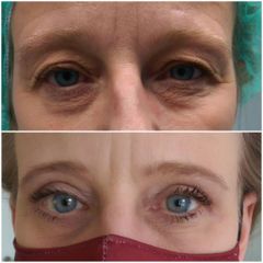 Operácia očných viečok (Blepharoplastika) - CRYSTAL ESTHETIC CLINIC