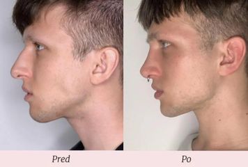 Operácia nosa (Rhinoplastika)