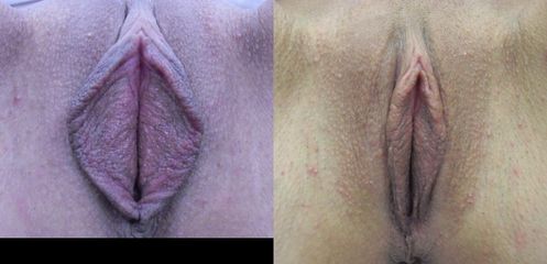 labio01