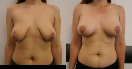 augmentácia a single-scar modelácia prsníkov