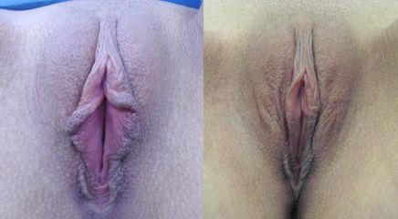 labio02