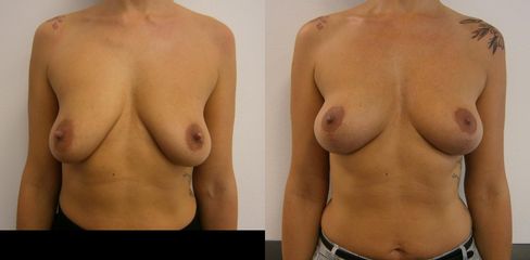 modelácia prsníkov single-scar