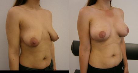 augmentácia a single-scar modelácia prsníkov