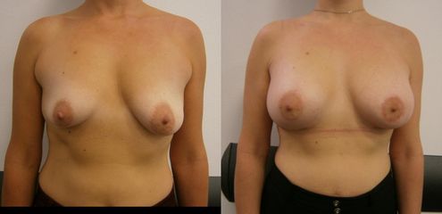 Asymetrická augmentácia s modeláciou ľavého prsníka