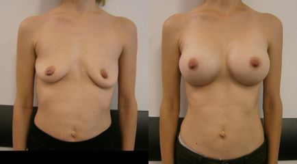 korekcia asymetrie prsníkov anatomickymi implantátmi Mentor
