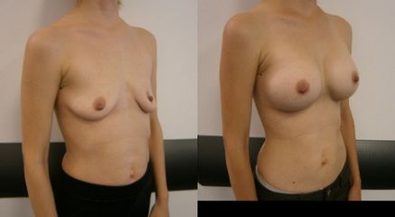 korekcia asymetrie prsníkov anatomickymi implantátmi Mentor