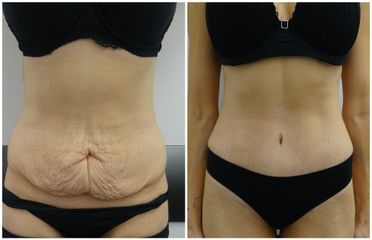 Abdominoplastika - MUDr. Imrich Kováč, MPH