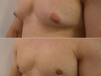 Gynekomastia pred a po - 878238