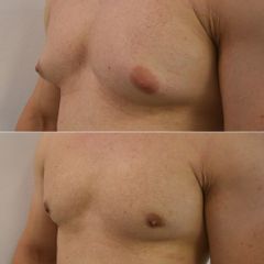 Gynekomastia - MUDr. Imrich Kováč, MPH