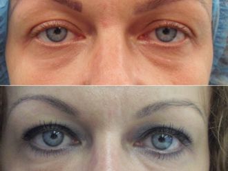 Blefaroplastika pred a po - 878239