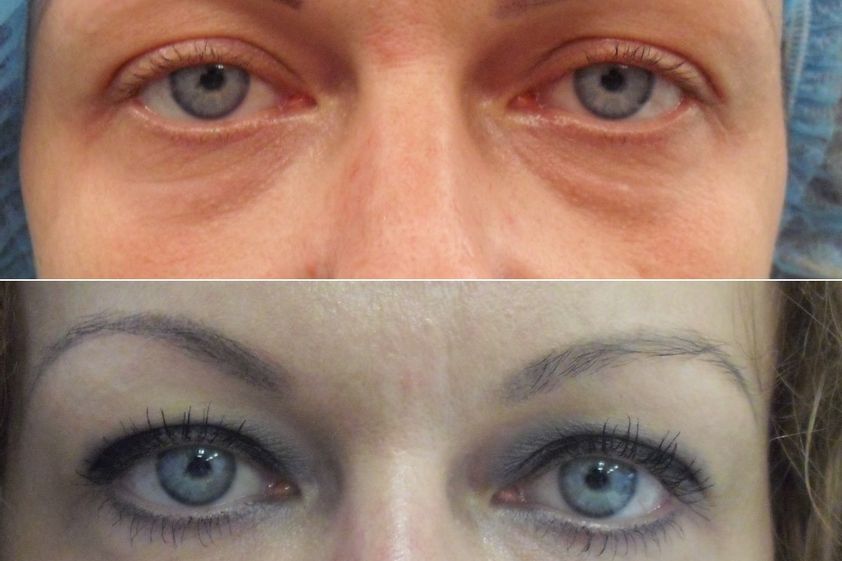 Blefaroplastika pred a po - 878239