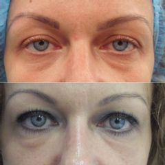 MUDr. Imrich Kováč, MPH - Blefaroplastika