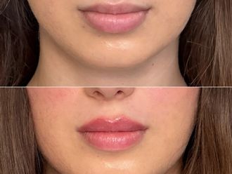 Zväčšenie pier pred a po - 879316