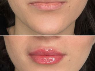 Zväčšenie pier pred a po - 879317