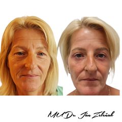 Blefaroplastika - MUDr. Ján Zeleňák