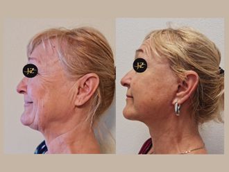 Facelift pred a po - 875643