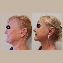 Facelift a Necklift