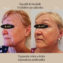 Facelift a Necklift MUDr. Ján Zeleňák